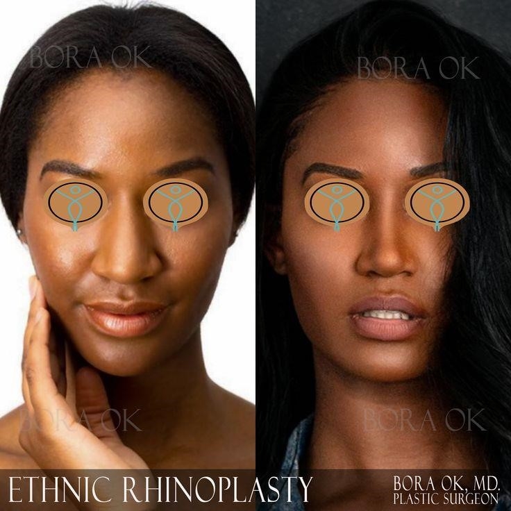 rhinoplasty experts