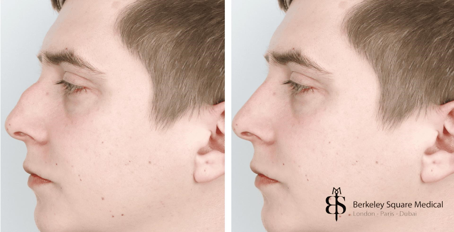 rhinoplasty expert nyc