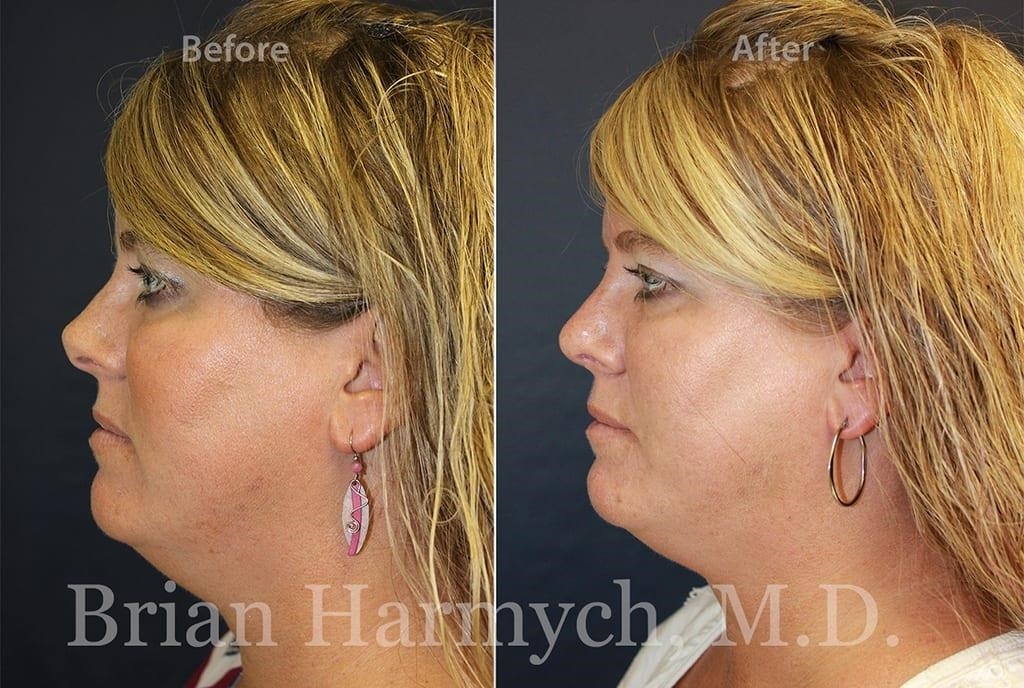 rhinoplasty expert nyc