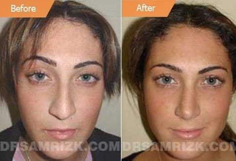 rhinoplasty expert nyc